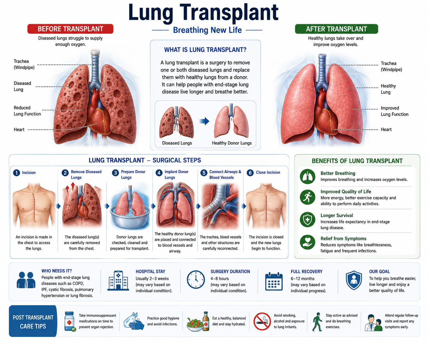 Lung Transplant — anatomy diagram